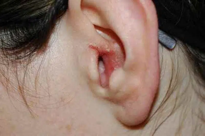 Comment savoir si on a un bouchon dans l’oreille